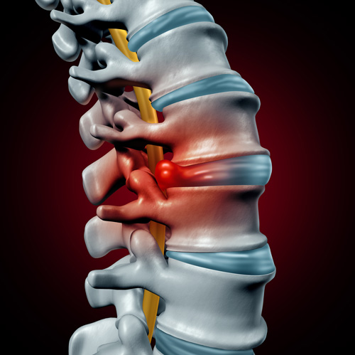 herniated disc