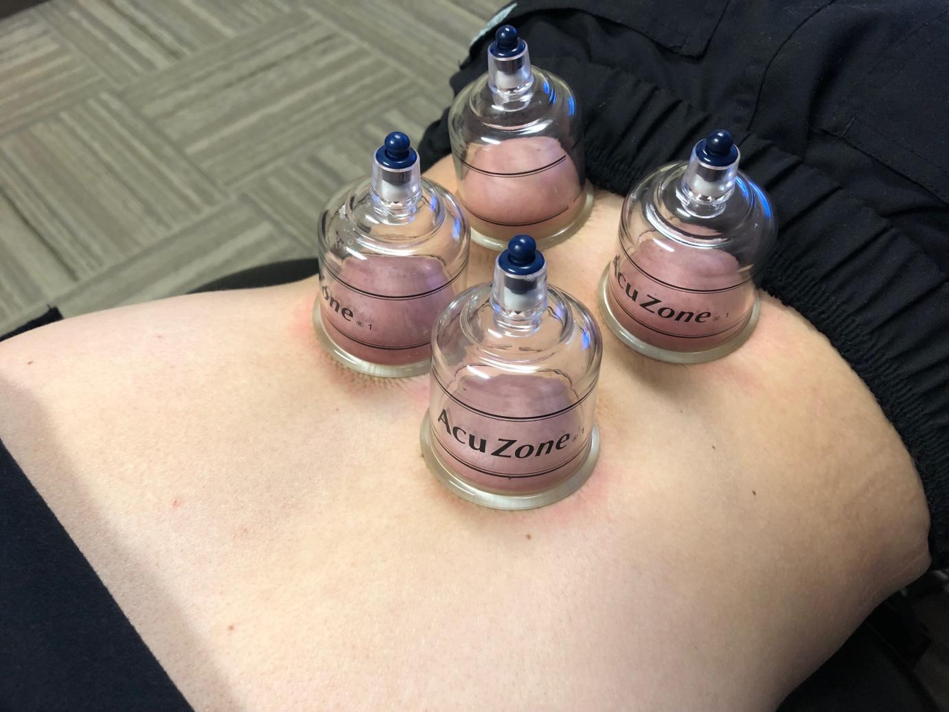 Medical Cupping Therapy